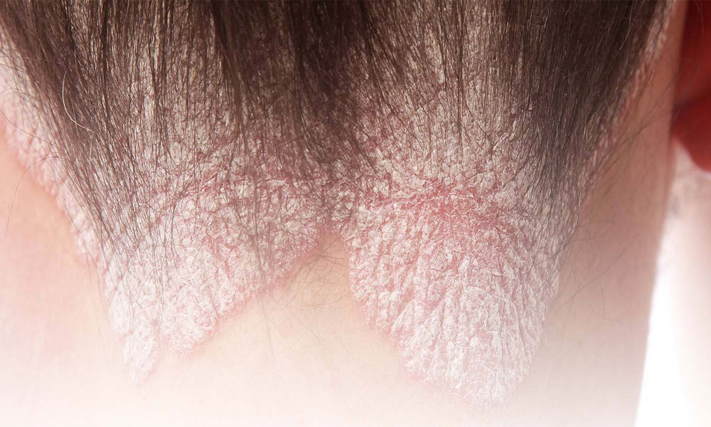 Scalp Psoriasis